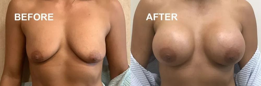 Comparison of breasts before and after surgery.