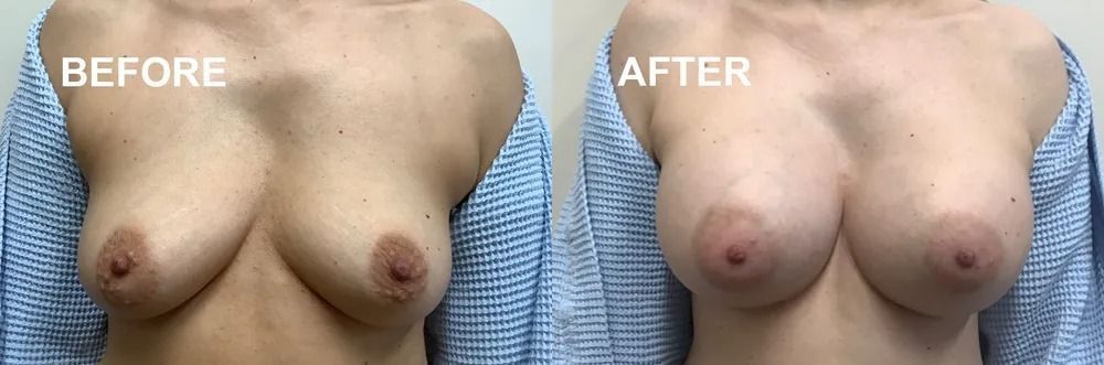 Side-by-side comparison of a person's chest labeled 