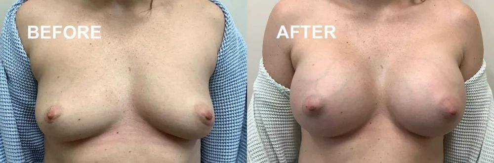 Side-by-side comparison shows breasts before and after procedure. The after breasts are larger and fuller.