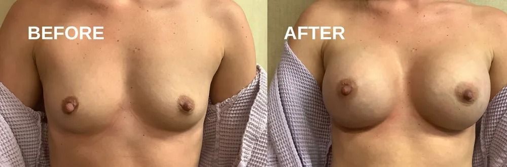 Breasts, before and after a procedure, shown side by side.