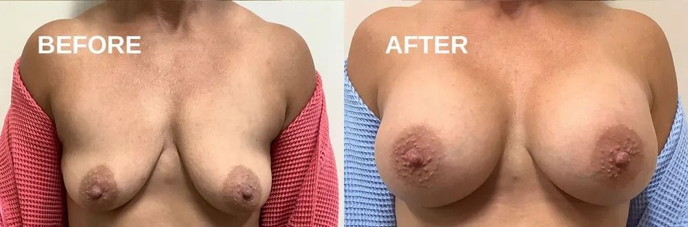 Side-by-side comparison of a person's chest labeled 