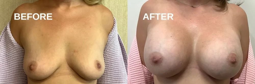 Side-by-side comparison of breasts before and after a procedure.