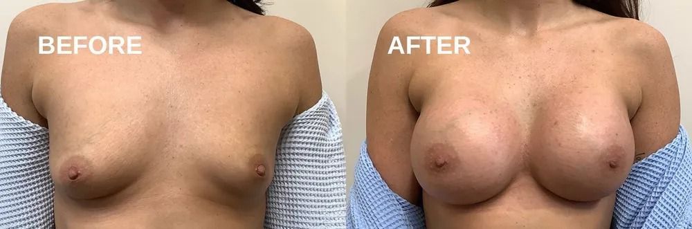Side-by-side comparison shows the chest before and after a procedure, with noticeably fuller breasts in the after photo.