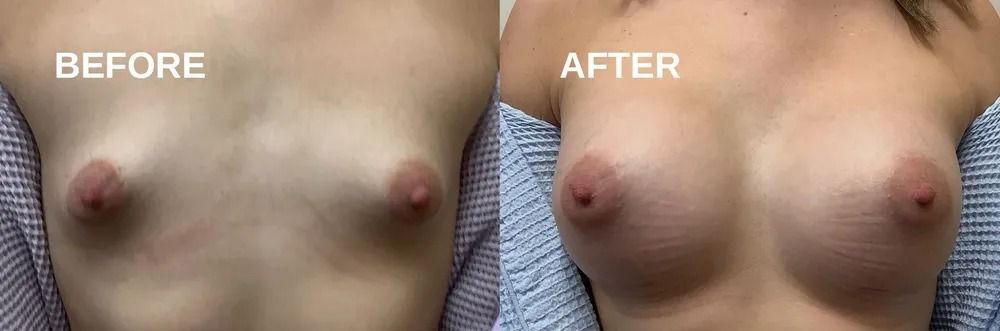 Side-by-side comparison of a chest, before and after a procedure. Breasts appear fuller and larger in the 