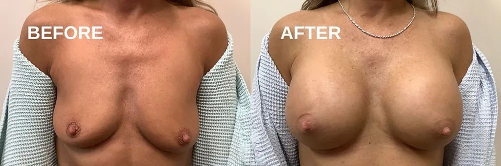 A comparison of breasts before and after a medical procedure. The 