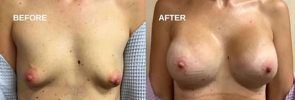 Breast augmentation comparison: before and after photos of a person's torso, breasts enlarged, nipples visible.