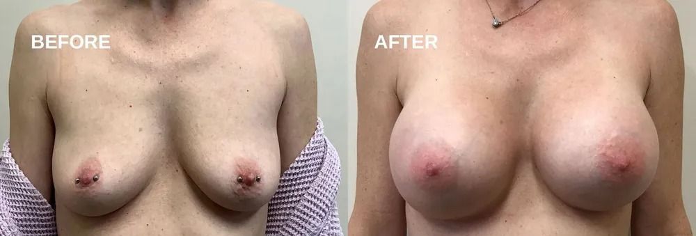 Side-by-side comparison of a person's chest before and after a breast augmentation procedure.