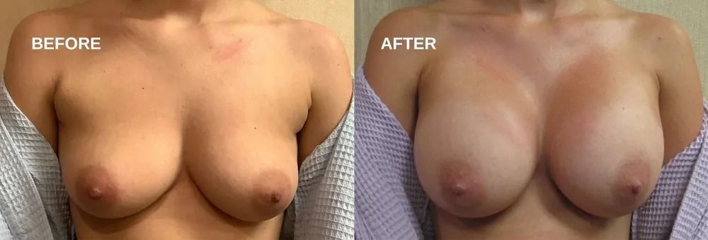 Comparison of breasts before and after surgery.