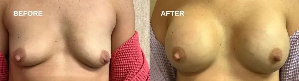 Side-by-side comparison of breasts before and after an unspecified procedure. The 