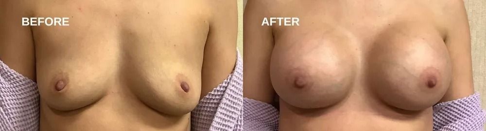 Side-by-side comparison of breasts before and after surgery, breasts are enlarged.