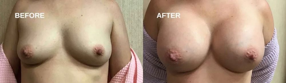 Comparison of before and after breast augmentation. Skin-toned breasts, with nipples; 