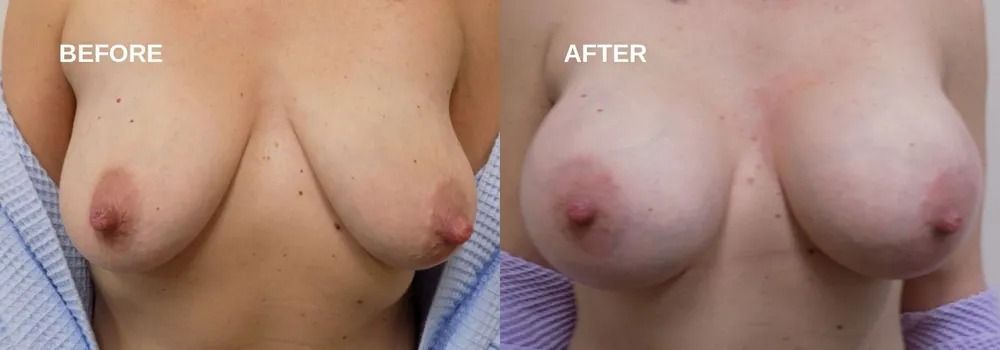 Comparison of a person's breasts before and after a cosmetic procedure. The after breasts appear larger and rounder.