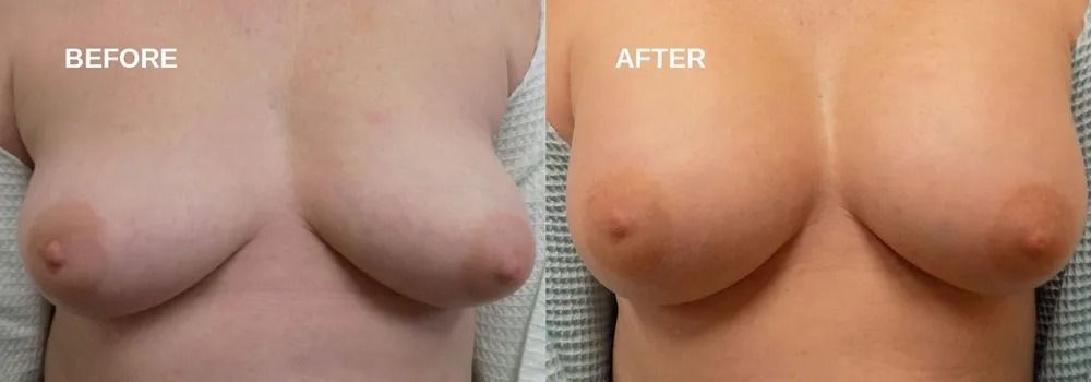 Comparison of breasts before and after augmentation, showing a change in size and shape.