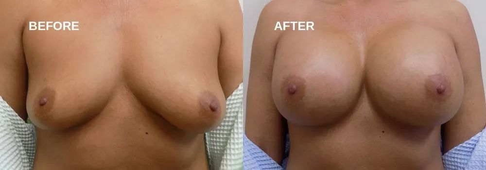 Side-by-side comparison of breasts before and after breast augmentation surgery.