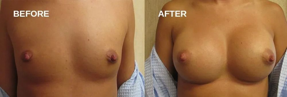 Comparison of a person's chest before and after a breast augmentation procedure.