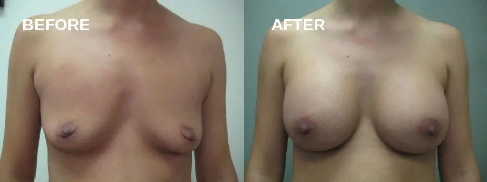 Comparison of breasts before and after surgery. The breasts are fuller and larger in the 