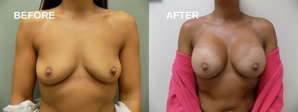 Comparison of breasts before and after surgery. The 