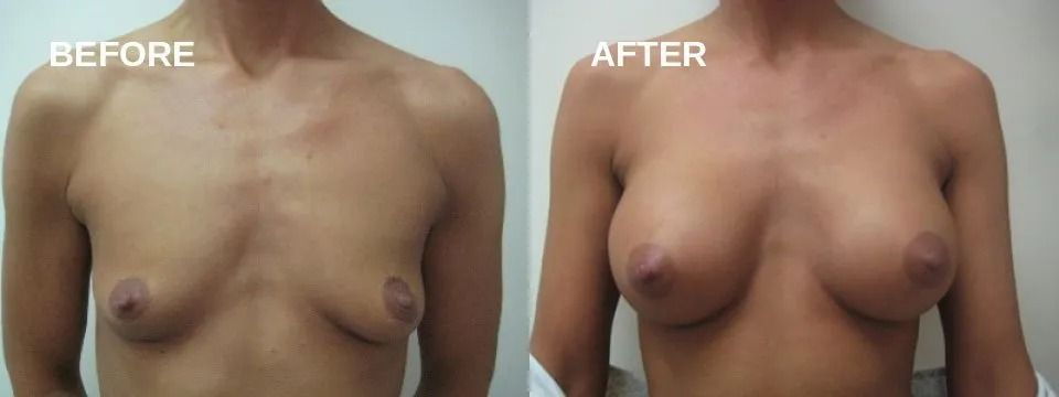 Side-by-side comparison of a person's chest before and after a cosmetic procedure, with text 