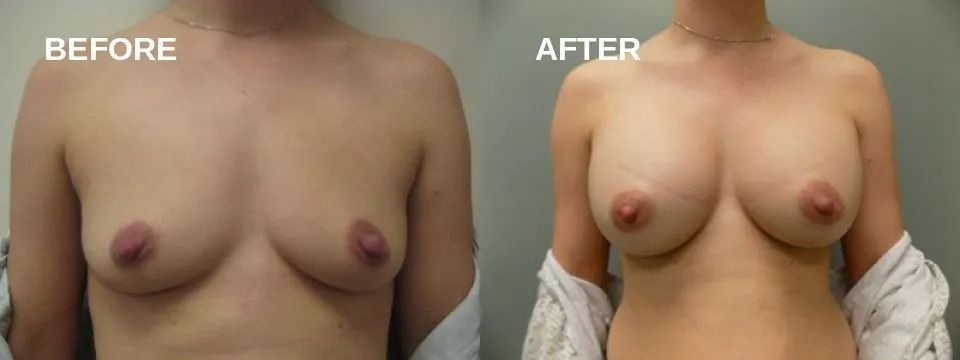 Before and after comparison of breasts, showing an increase in size.