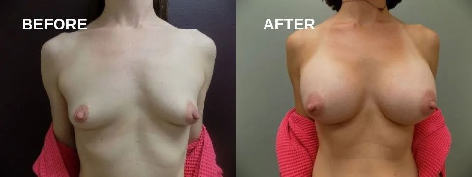 Side-by-side comparison of a person's chest before and after a cosmetic procedure.