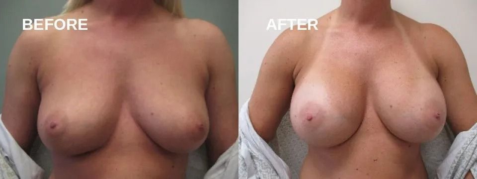 Side-by-side comparison of a woman's breasts. Left side: 
