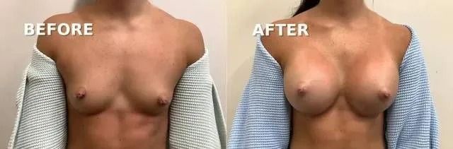 A comparison of a person's chest before and after a cosmetic procedure, showing increased breast size.