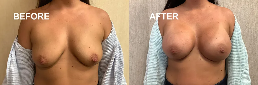 Side-by-side comparison. Woman's breasts before and after procedure; fuller appearance.
