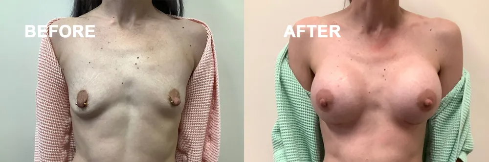Side-by-side comparison. Before and after view of a person's chest, showing a change in breast size.