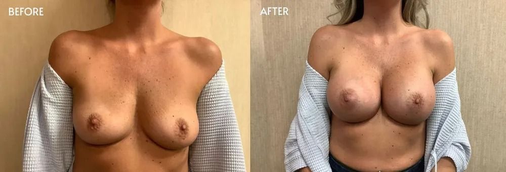 Before and after breast augmentation. Skin-toned woman in a gray sweater. Breasts appear larger on the right.