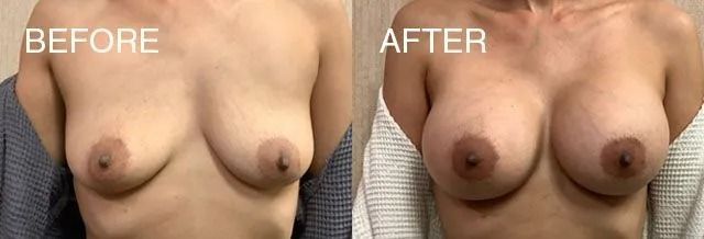 Side-by-side comparison of breasts: before and after. 