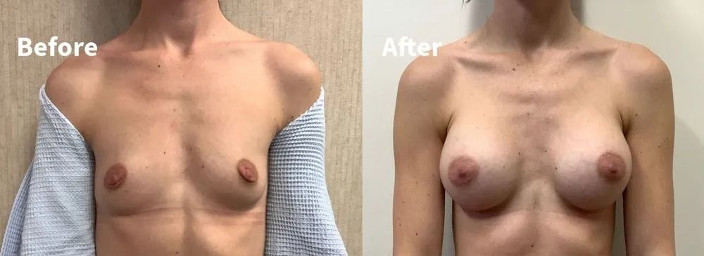 Side-by-side comparison of a person's chest: before and after breast augmentation.
