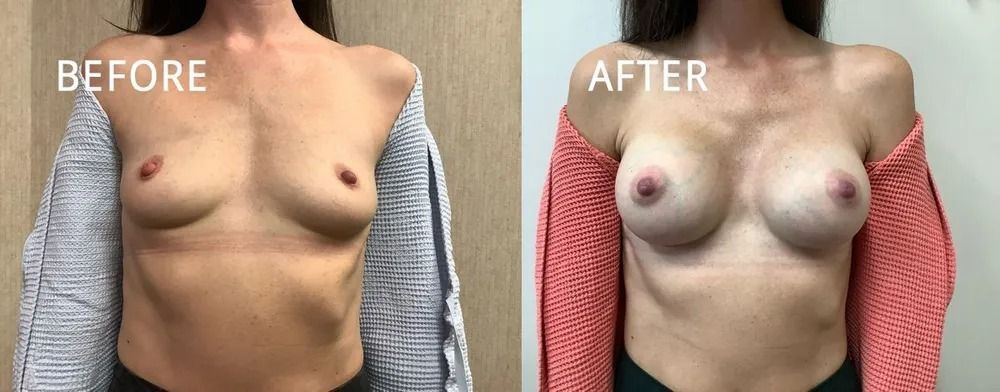 Side-by-side comparison shows a person's chest before and after breast augmentation.