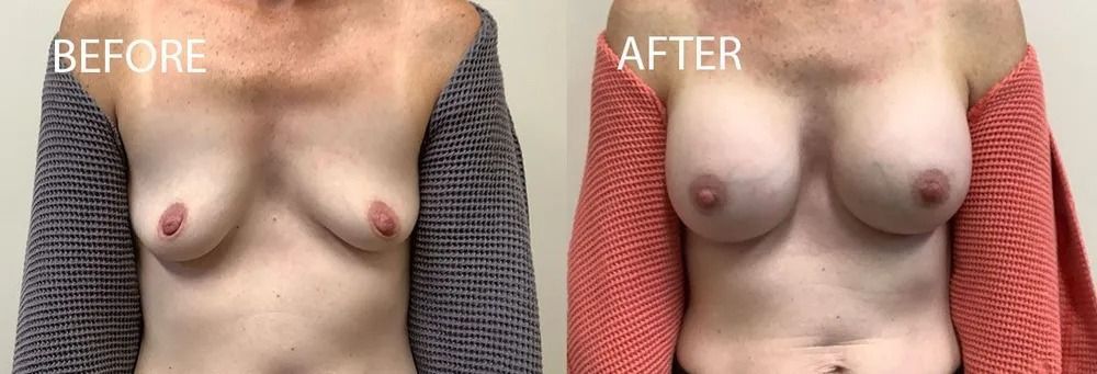 Before and after view of breasts, with slight increase in size after the procedure.