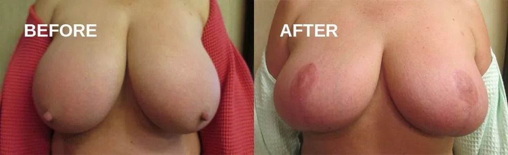 Before and after view of breasts, possibly from a medical procedure.