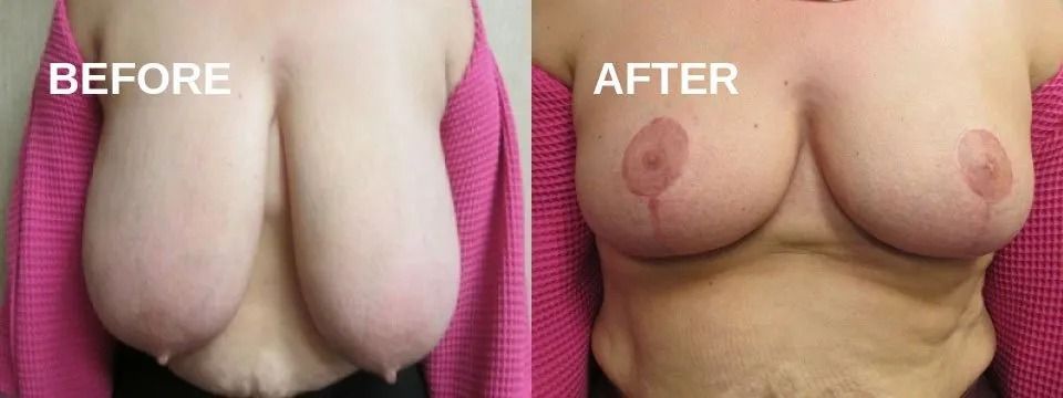 Side-by-side comparison of breasts before and after a procedure. The 
