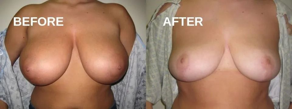 Side-by-side comparison of a woman's breasts. Left: larger. Right: smaller, post-procedure.