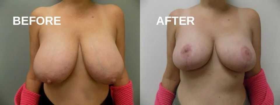 Side-by-side comparison of breasts before and after a procedure. The 
