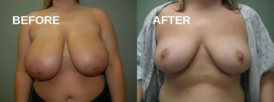 Side-by-side comparison of a person's chest before and after a procedure. The 