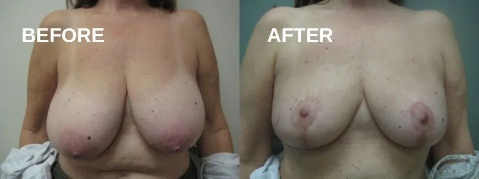 Side-by-side comparison of breasts before and after a procedure.