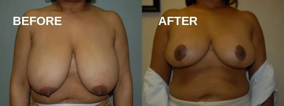 Before and after comparison of a person's chest after a procedure.