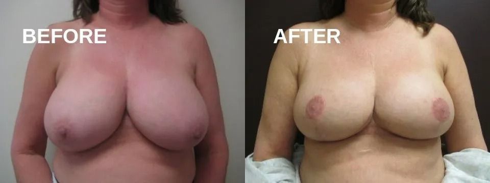 Side-by-side comparison: Before and after breast augmentation. Skin-toned breasts, with nipples. 