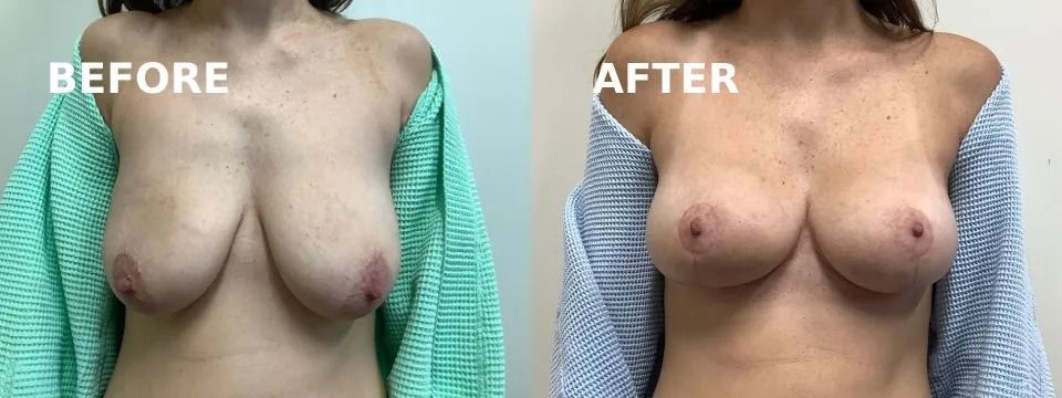 Side-by-side comparison of breasts before and after a cosmetic procedure, with text labels 
