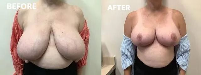 Side-by-side comparison of a person's chest before and after a procedure, showing a reduction in size.