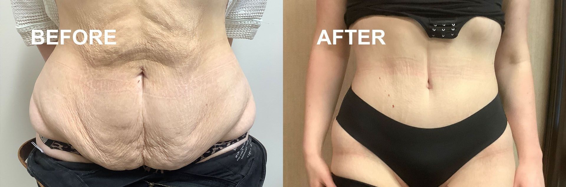 Before and after photo of a person's abdomen, showing loose skin. The 