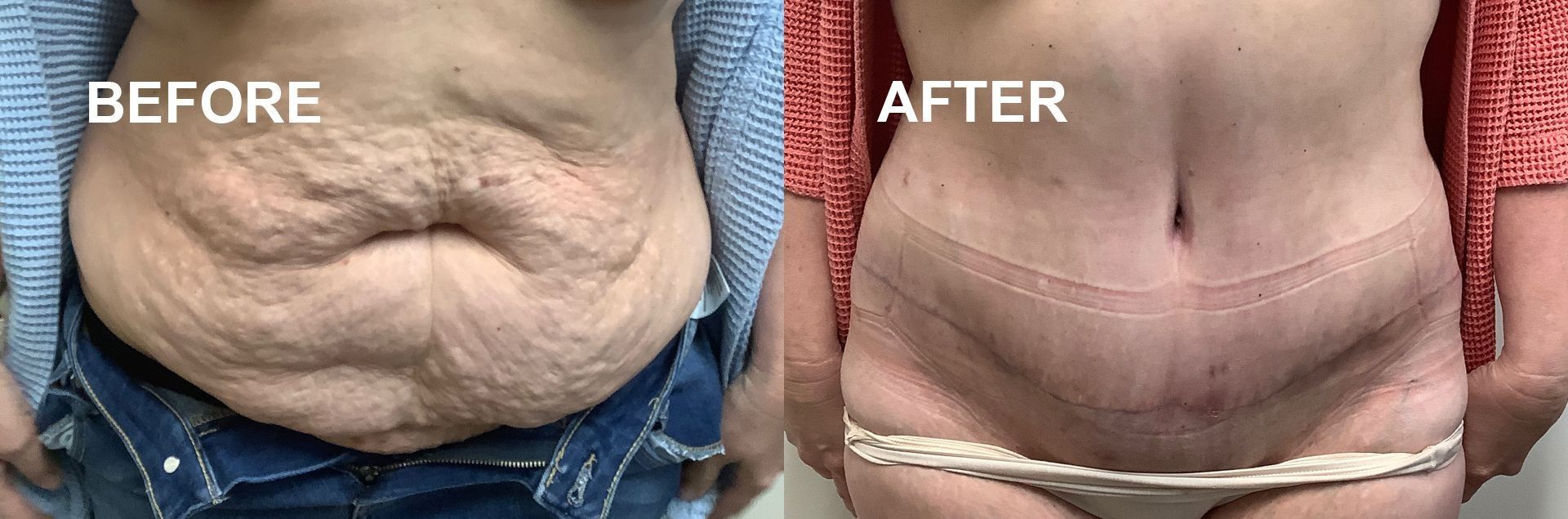 Side-by-side belly shots: 