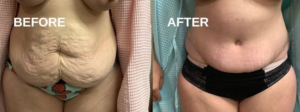 Comparison of a person's abdomen, 