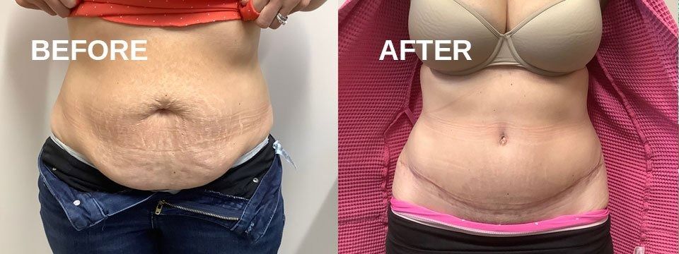 Before and after photos of a person's abdomen. 