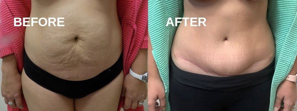 Side-by-side comparison of a person's abdomen, before and after a medical procedure. The 