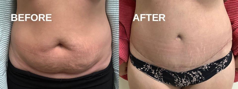 Side-by-side comparison of a person's abdomen, labeled 