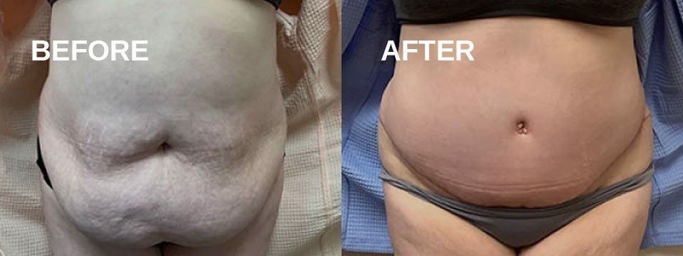 Side-by-side belly comparison. Before photo shows a plump belly. After shows a trimmer belly.